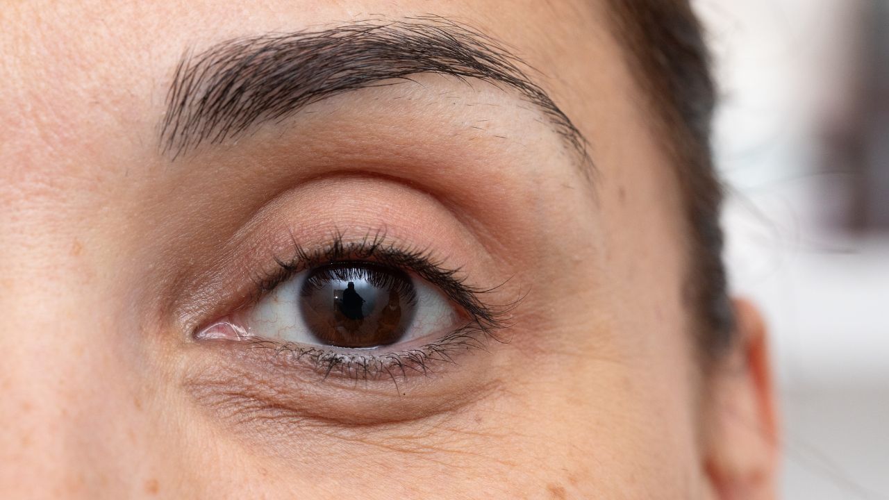 tmavé kruhy pod očima